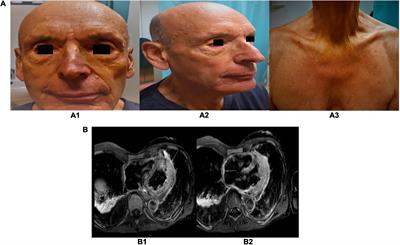 Genetics and clinical phenotype of Erdheim–Chester disease: A case report of constrictive pericarditis and a systematic review of the literature